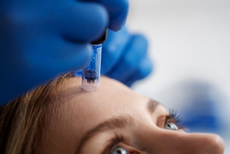 Patient subissant une procédure de microneedling sur le visage